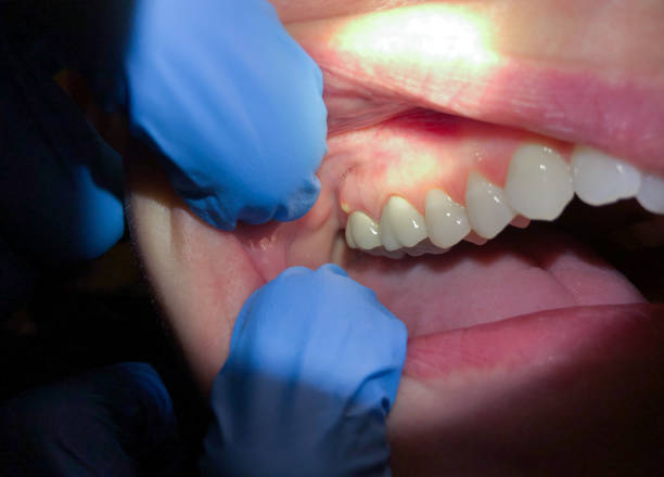 Best Emergency Root Canal Treatment in Rancho Laveras, CA